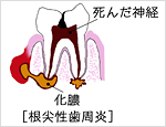 根尖性歯周炎図1